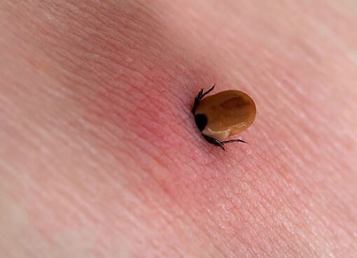 برغوث أم بعوض.. كيف تميّز لدغات الحشرات؟ وما علاجها؟