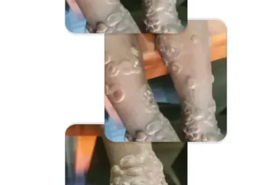 كارثة صحية..  انتشار مرض معدي خطير في محافظة إب (صور)