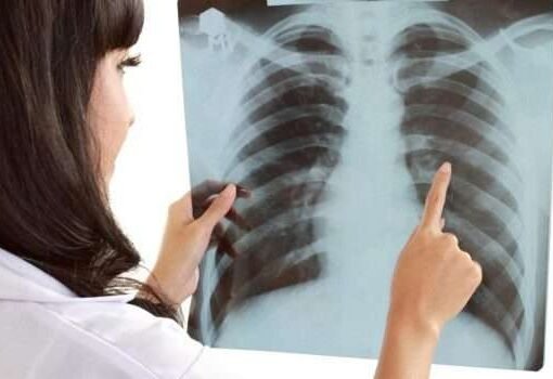 دراسة تكشف سببا مقلقا لسرطان الرئة يهدد غير المدخنين أكثر