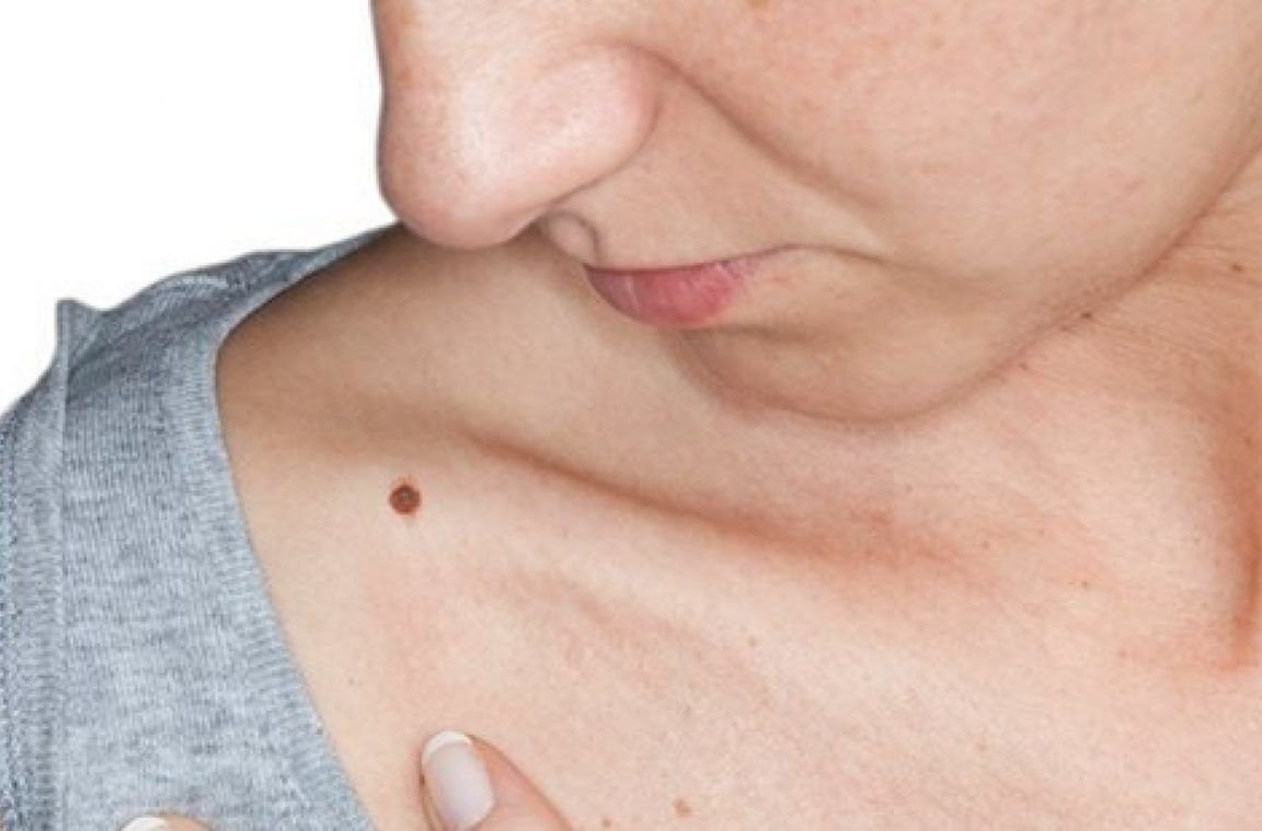 تعرف على علامات لتشخيص الشامة السرطانية