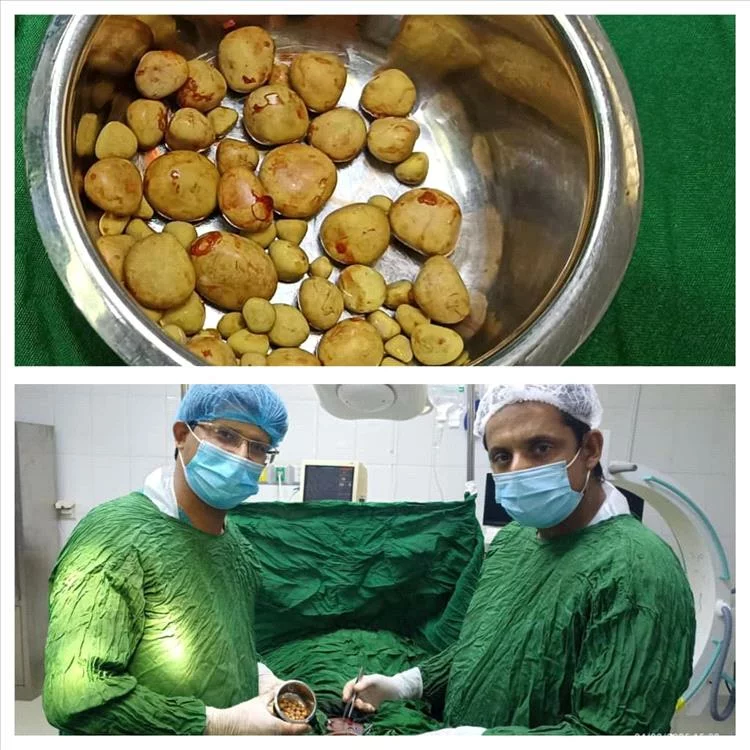 لن تصدق ..عملية نادرة لمسن يمني استخراج 61 حصوة  في جراحة معقدة!