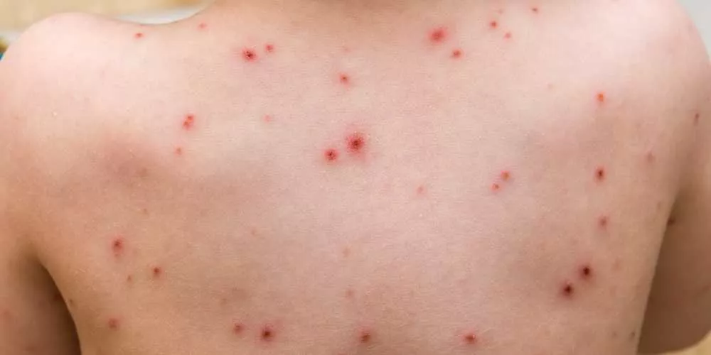اعلان رسمي بشأن وباء خطير يحتاج هذه المحافظه اليمنيه