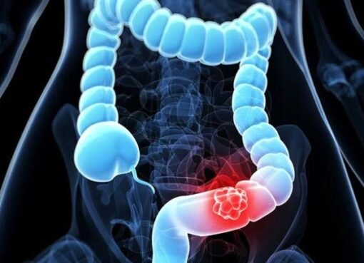 أقوى مشروب لتسكين آلام القولون في أيام قليلة ستلاحظ اختفاء الألم و الإمساك