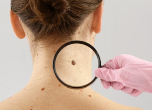 علامة تحذيرية على مرض خطير لظهور الشامات المفاجئة