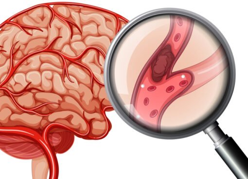 توجه ج فوراً.مختص يكشف عن علامة تحذيرية تظهر قبل حدوث الجلطة بأسبوع