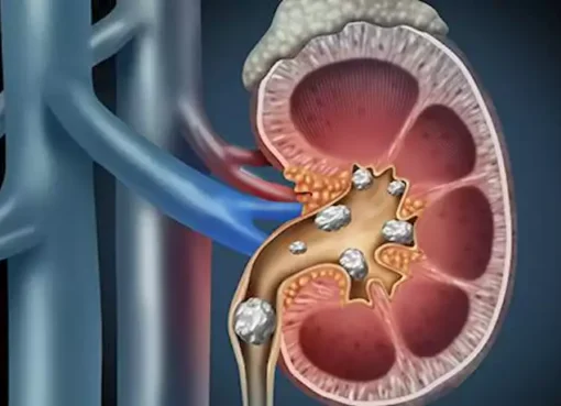 5 عادات بسيطة قد تمنع حصوات الكلى