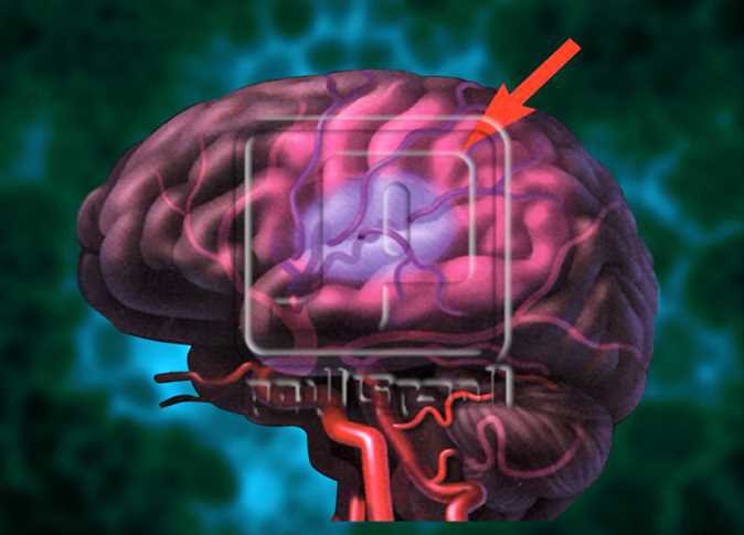 انتبه إلى هذه العلامة الصغيرة في عينيك: قد تكون علامة على سكتة دماغية قادمة: كيفية التعرف عليها
