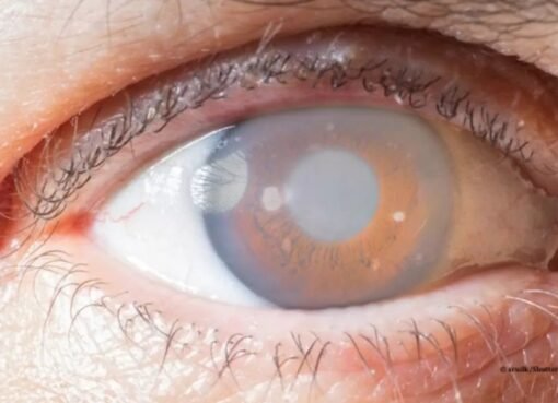 تعرف على الجلوكوما: السبب الرئيسي لعمى 10% من السكان في المملكة