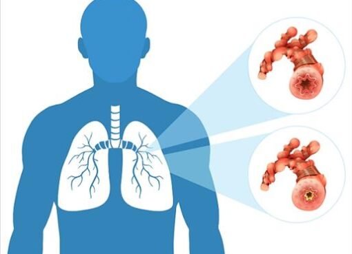 من نكهة الفشار إلى كارثة صحية: القصة الكاملة وراء مرض التهاب القصيبات المسدودة