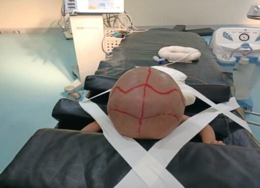 "إنجاز طبي غير مسبوق في مأرب: نجاح عملية جراحية دقيقة لإنقاذ رضيع من استسقاء دماغي حاد"