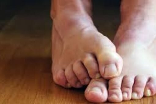 علامات تظهر على القدمين تنذر بالسكتة القلبية .. لا تتجاهلها