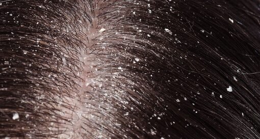 وداعًا لقشرة الشعر: حلول طبيعية 100% لتليين فروة الرأس