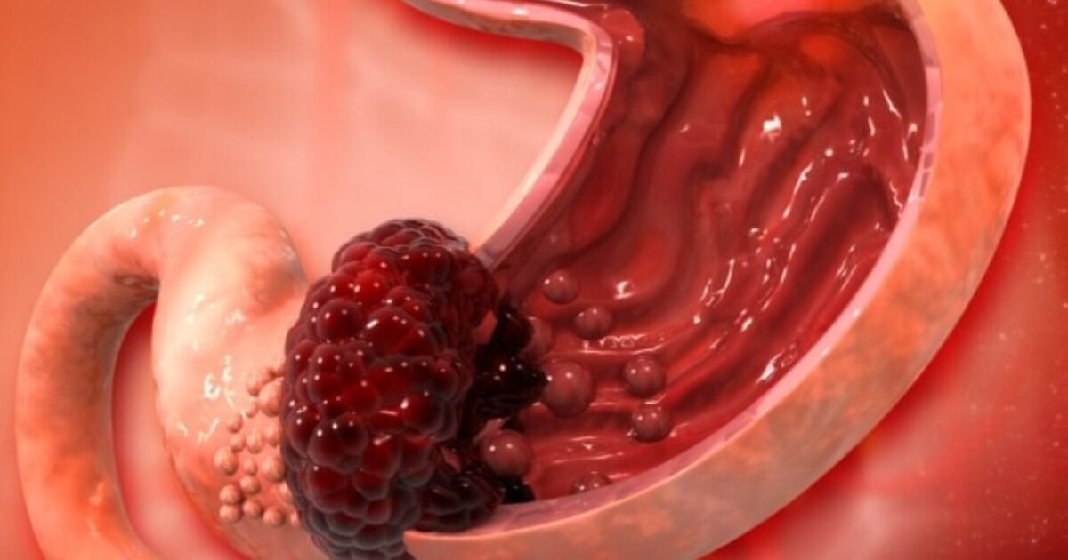 لا تتجاهلها: أعراض سرطان المعدة الخفية وخط دفاعك الأول بـ 5 أطعمة وقائية!
