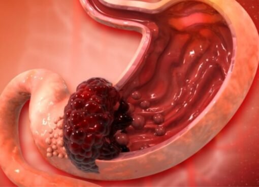 لا تتجاهلها: أعراض سرطان المعدة الخفية وخط دفاعك الأول بـ 5 أطعمة وقائية!