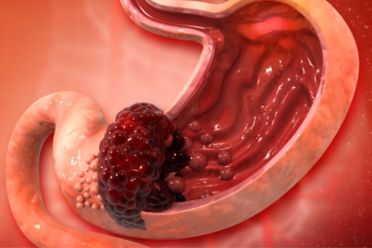 لا تتجاهلها: أعراض سرطان المعدة الخفية وخط دفاعك الأول بـ 5 أطعمة وقائية!