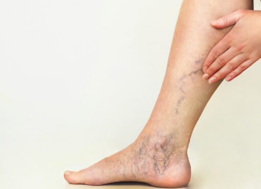 مفاجأة طبية: الدوالي قد تزيد خطر الإصابة بالخرف!