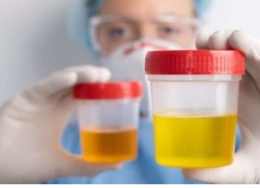 احذر هذا اللون في بولك... قد يشير إلى مشكلة صحية خطيرة!