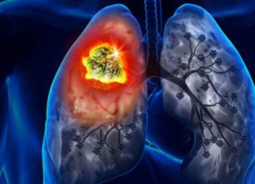 وداعًا للسموم.. أفضل مشروب طبيعي لتنظيف الرئتين بعد الإقلاع عن التدخين