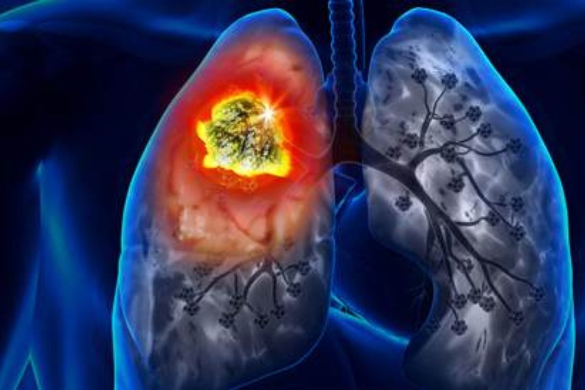 وداعًا للسموم.. أفضل مشروب طبيعي لتنظيف الرئتين بعد الإقلاع عن التدخين