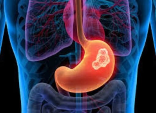 تخفيف الحموضة بدون دواء: مشروبات طبيعية تهدئ معدتك