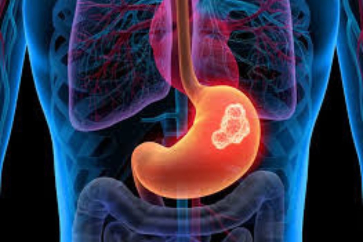 لن تحتاج للأدوية مجددًا.. أعشاب منقوعة تخلصك من حرقة المعدة