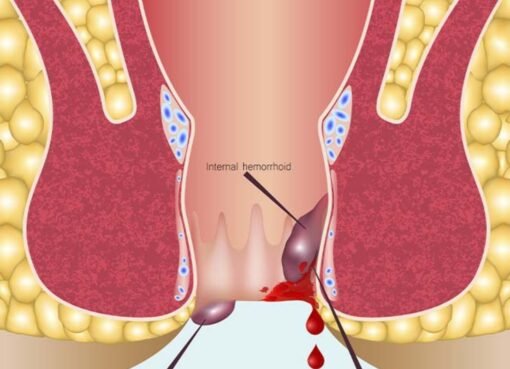 تجنّب هذه الأطعمة فورًا إذا كنت تعاني من البواسير