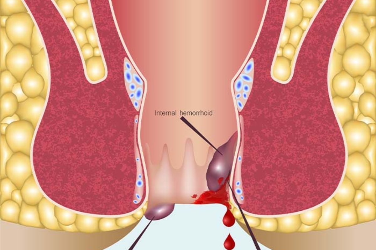 تجنّب هذه الأطعمة فورًا إذا كنت تعاني من البواسير