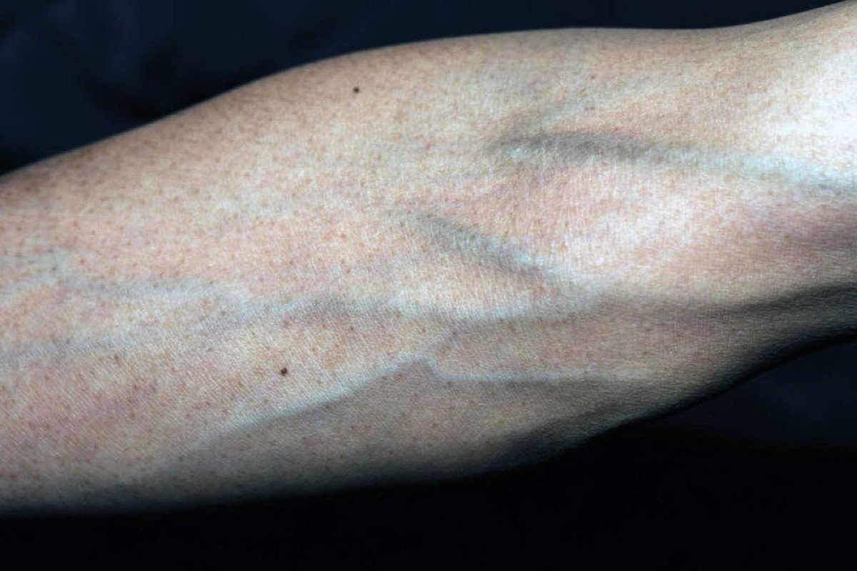 العروق الزرقاء في اليد: إشارات خفية لصحتك لا يجب تجاهلها