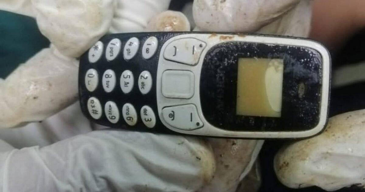 ابتلعه قبل عامين.. استخراج هاتف من معدة مواطن مصري دون جراحة!