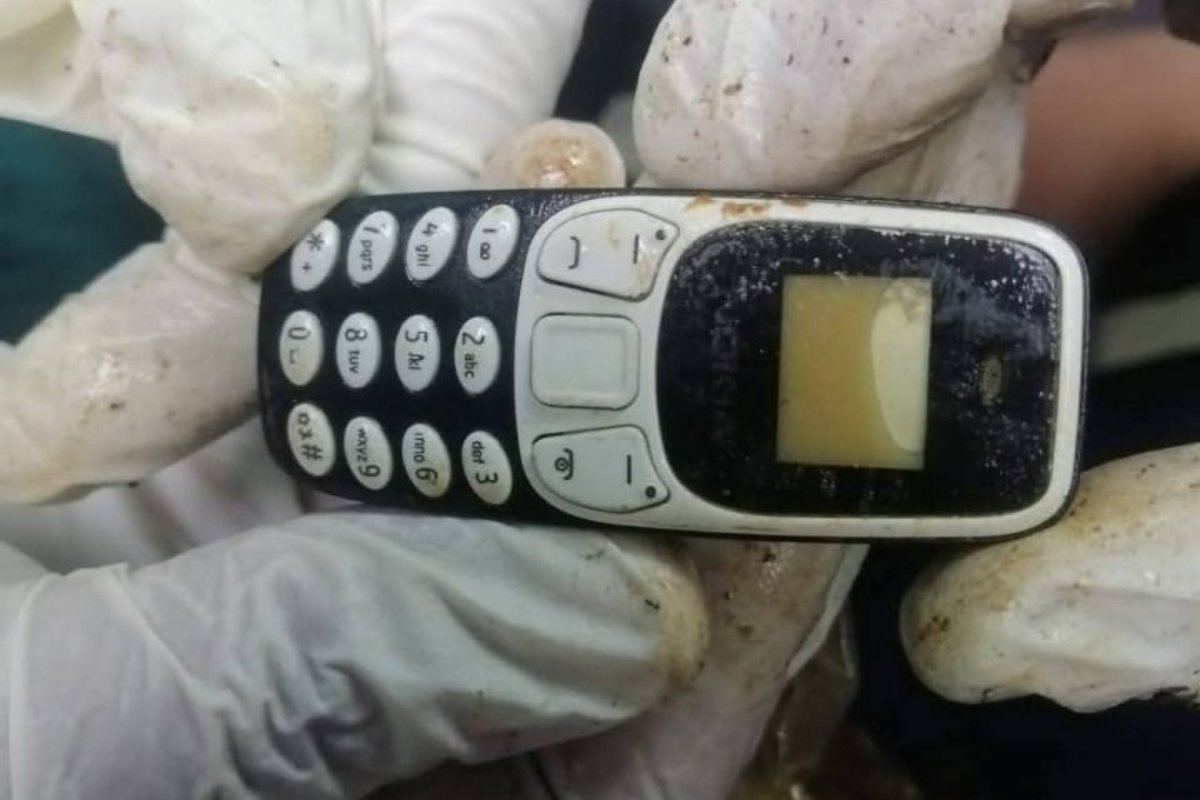 ابتلعه قبل عامين.. استخراج هاتف من معدة مواطن مصري دون جراحة!