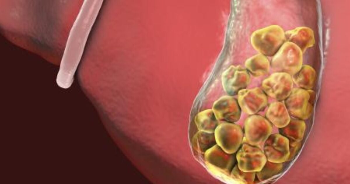 وداعًا للألم: علاجات طبيعية لحصى الكلى دون أدوية
