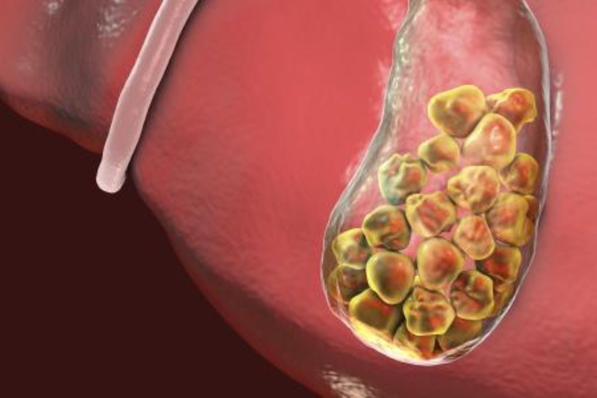 وداعًا للألم: علاجات طبيعية لحصى الكلى دون أدوية