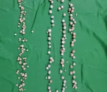 إنجاز طبي نادر في اليمن: إزالة مئات الحصوات دون تدخل جراحي