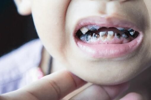 كيف تحمي أطفالك من تسوس الأسنان؟ الأسباب، الأعراض، والعلاجات الحديثة