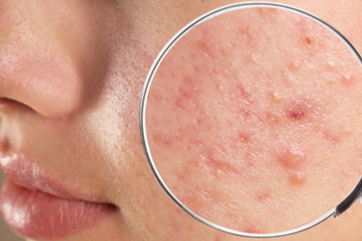 بخطوات بسيطة.. تخلصي من حب الشباب في المنزل دون تكلفة