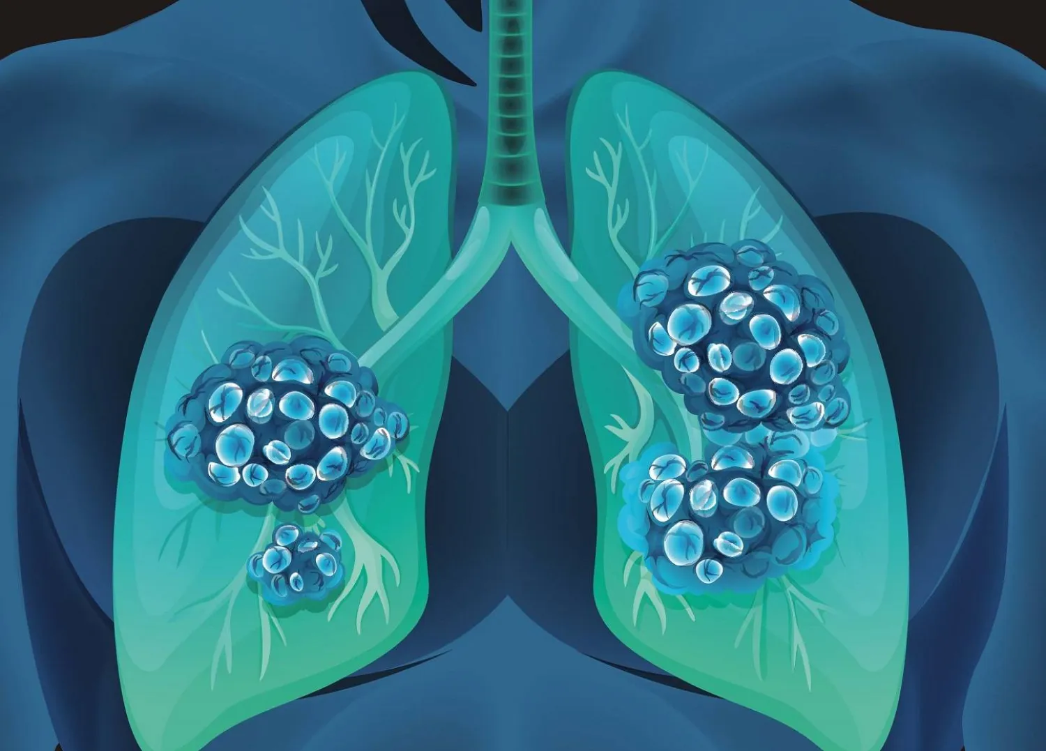 تقدّم طبي مذهل: علاج جديد لسرطان الرئة يحقق نسبة نجاح 90٪