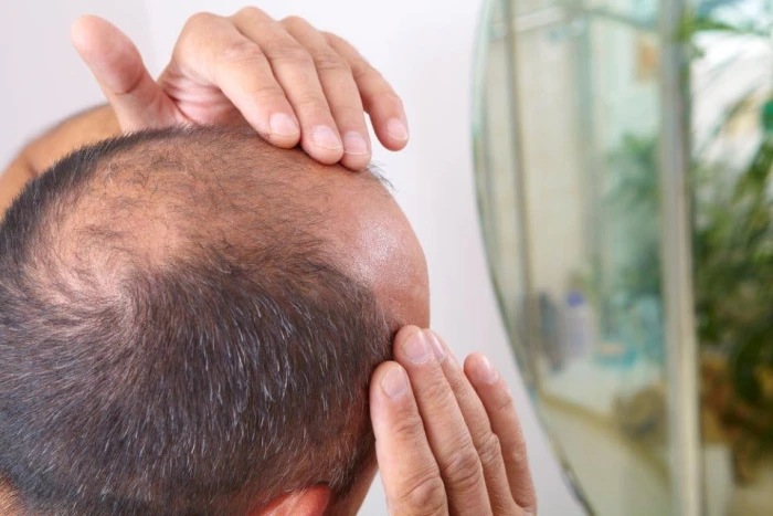 اكتشاف علمي يعيد الأمل لمرضى الصلع الوراثي بدون أدوية أو زراعة