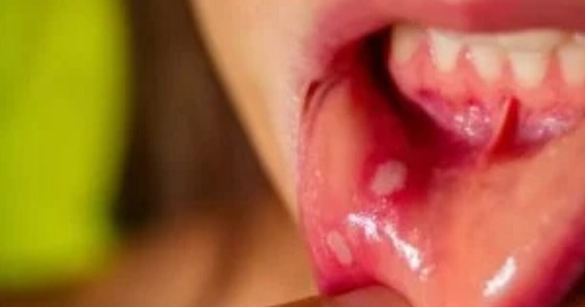 احذر هذه العلامات في فمك قبل فوات الأوان