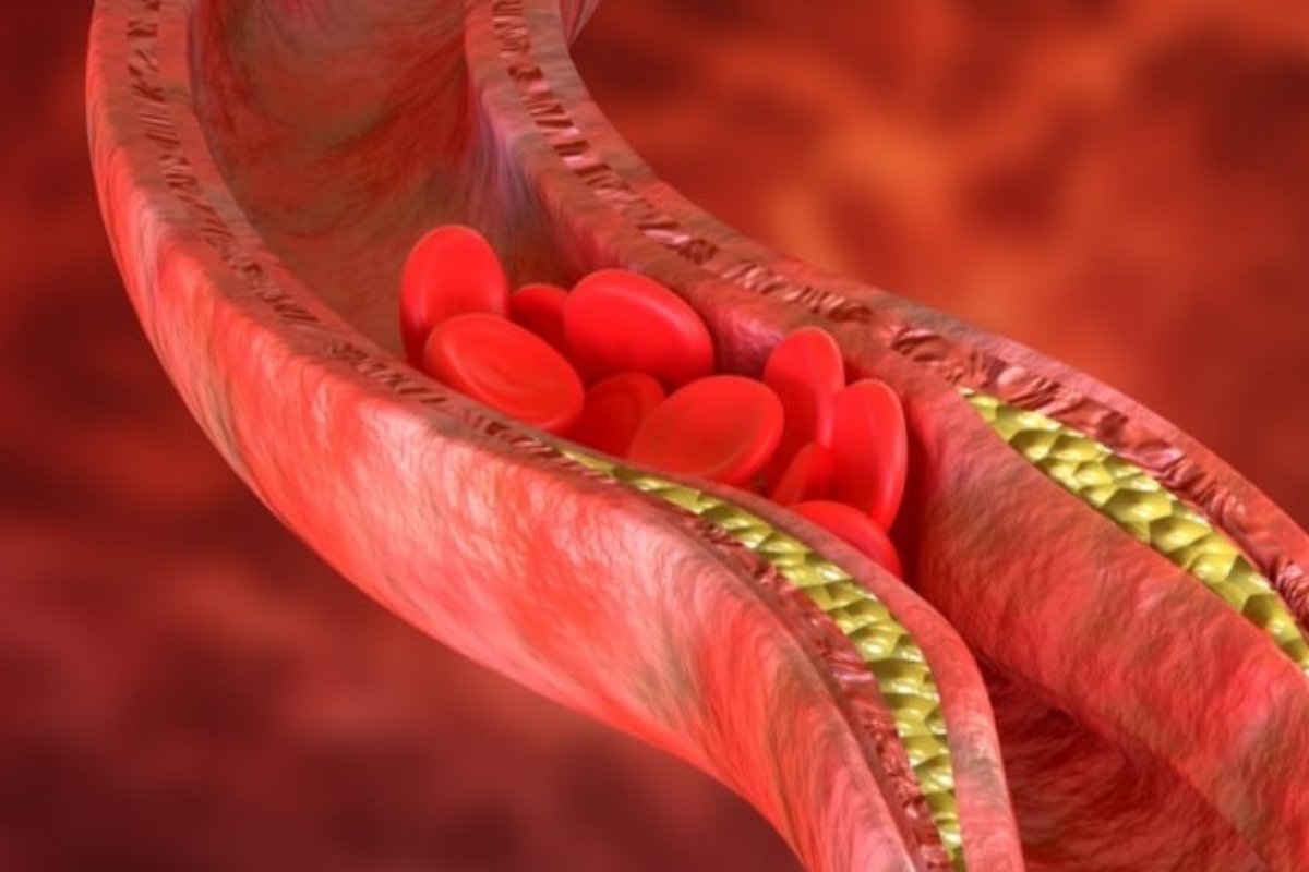 غذاء واحد يُحدث ثورة في الطب... ينظّف الشرايين خلال أيام!