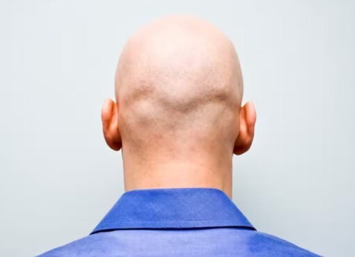 مفاجأة علمية: الرجل الأصلع لا يُصاب بهذا المرض الخطير!