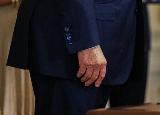 ما وراء الكدمة الزرقاء؟ طبيب ترامب يكشف الحقيقة