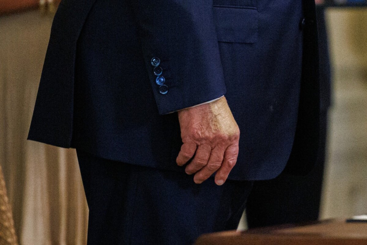 ما وراء الكدمة الزرقاء؟ طبيب ترامب يكشف الحقيقة