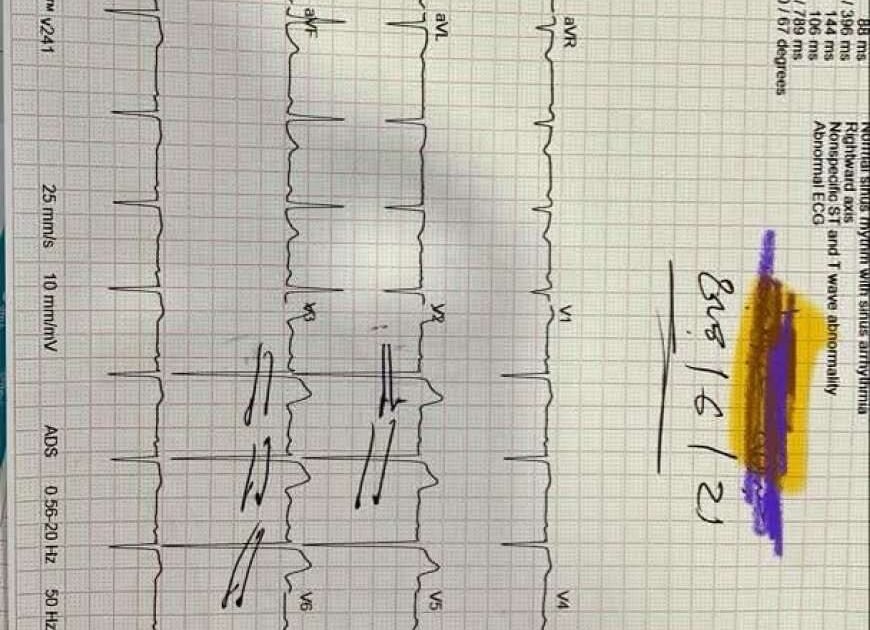 منتج غامض يتسبب بجلطات قلبية… والطبيب الماتري يطالب بتدخل عاجل